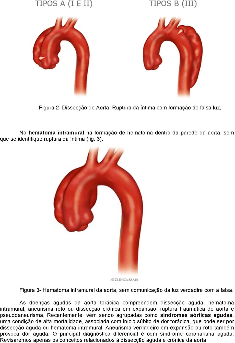 As doenças agudas da aorta torácica compreendem dissecção aguda, hematoma intramural, aneurisma roto ou dissecção crônica em expansão, ruptura traumática de aorta e pseudoaneurisma.