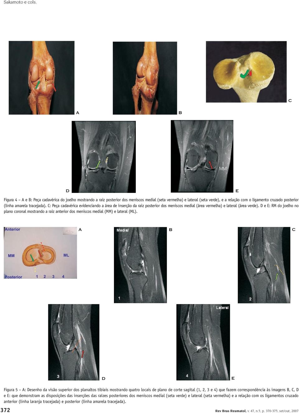 tracejada). C: Peça cadavérica evidenciando a área de inserção da raiz posterior dos meniscos medial (área vermelha) e lateral (área verde).