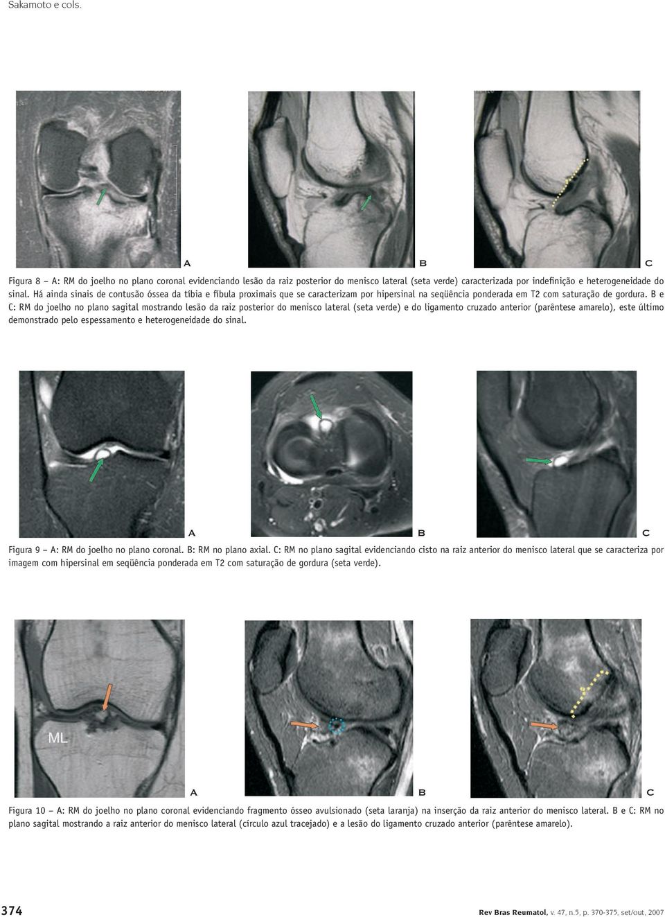 e C: RM do joelho no plano sagital mostrando lesão da raiz posterior do menisco lateral (seta verde) e do ligamento cruzado anterior (parêntese amarelo), este último demonstrado pelo espessamento e