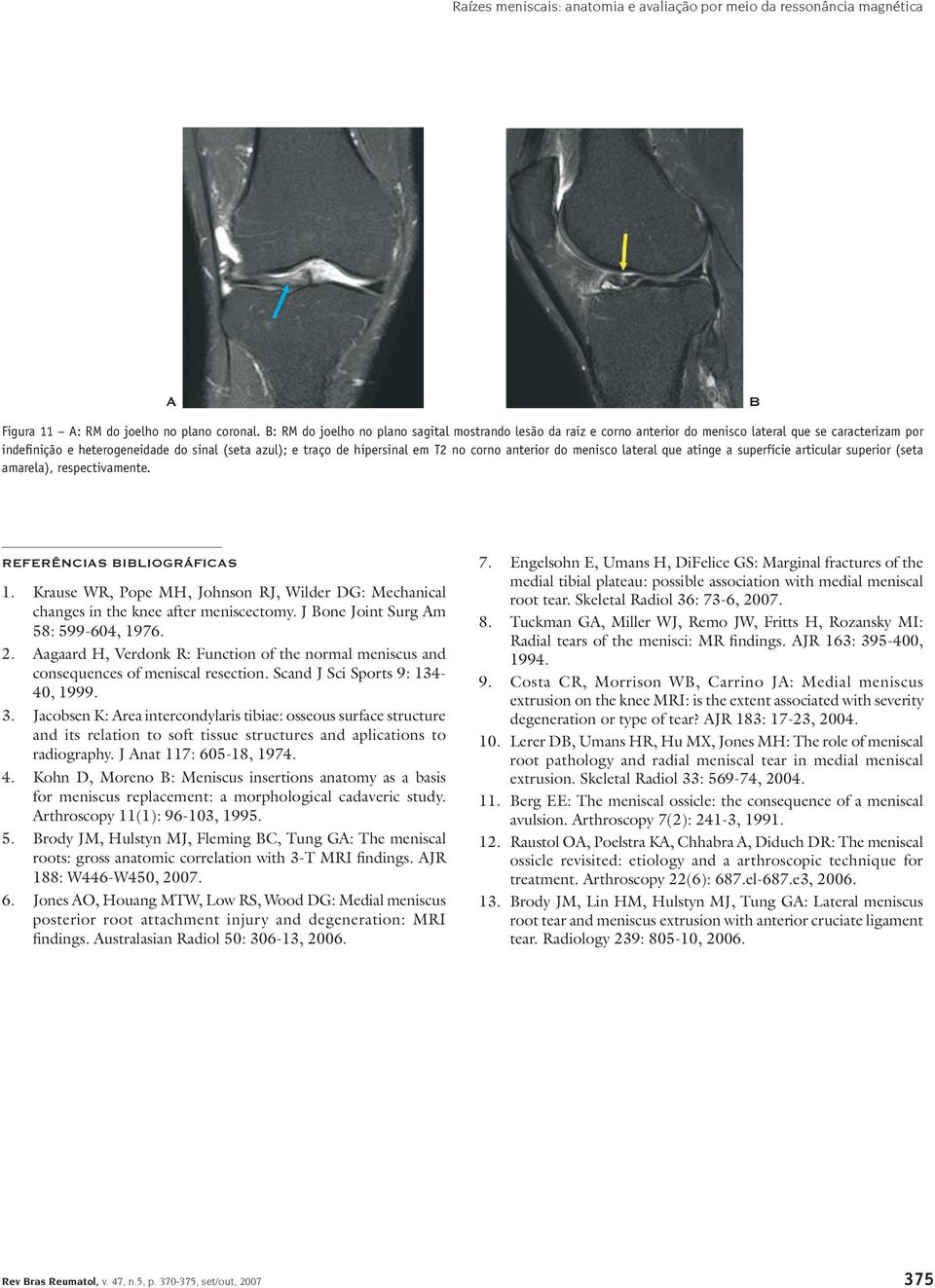 corno anterior do menisco lateral que atinge a superfície articular superior (seta amarela), respectivamente. REFERÊNCIS ILIOGRÁFICS 1.