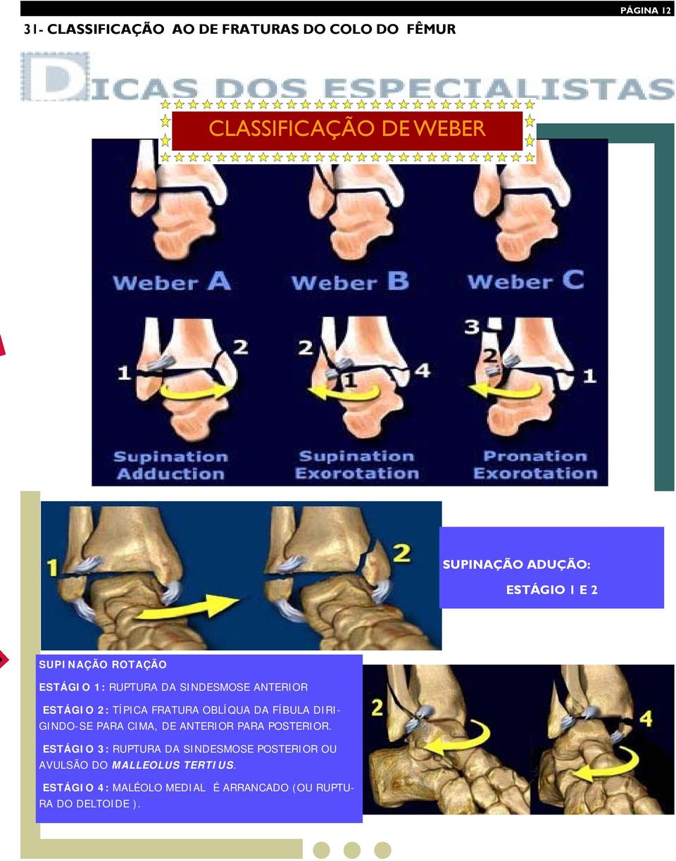 OBLÍQUA DA FÍBULA DIRI- GINDO-SE PARA CIMA, DE ANTERIOR PARA POSTERIOR.