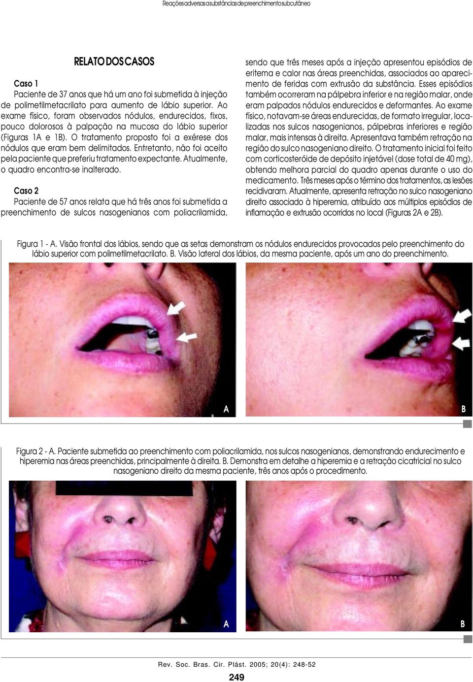 o exame físico, foram observados nódulos, endurecidos, fixos, pouco dolorosos à palpação na mucosa do lábio superior (Figuras 1 e 1).