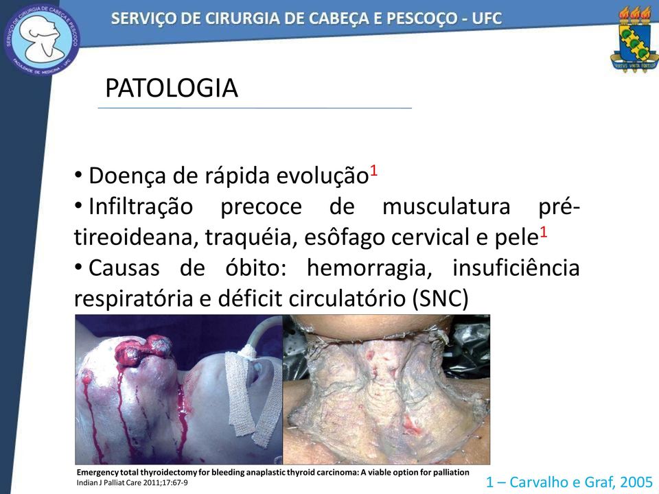 e déficit circulatório (SNC) Emergency total thyroidectomy for bleeding anaplastic thyroid