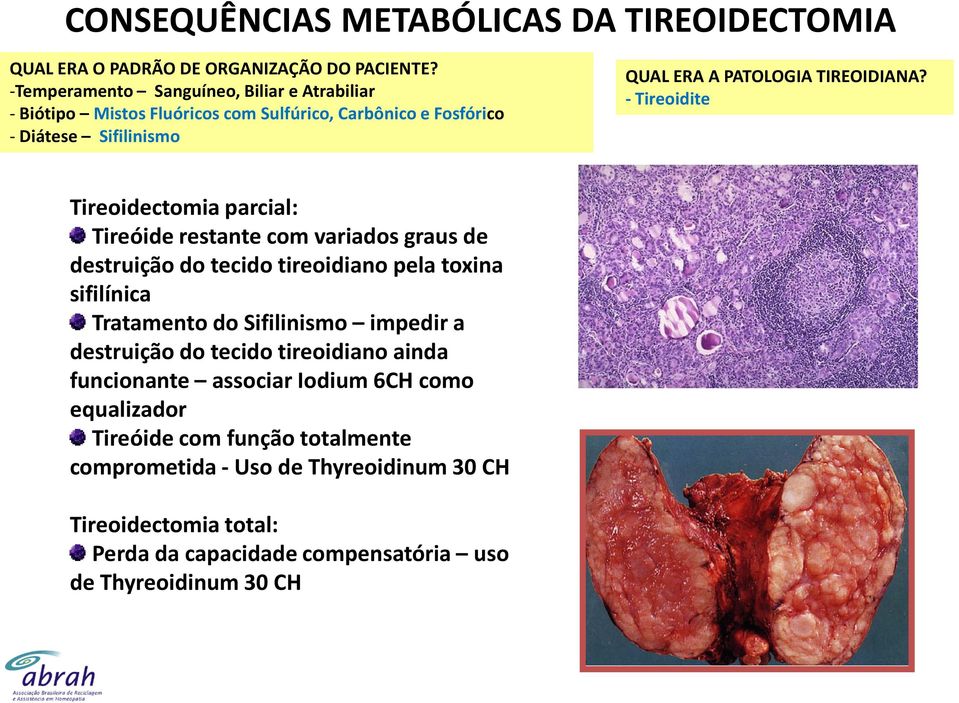 - Tireoidite Tireoidectomia parcial: Tireóide restante com variados graus de destruição do tecido tireoidiano pela toxina sifilínica Tratamento