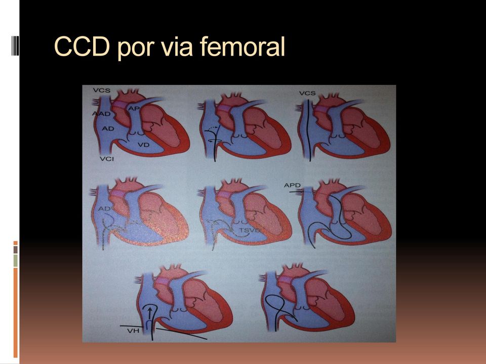 femoral