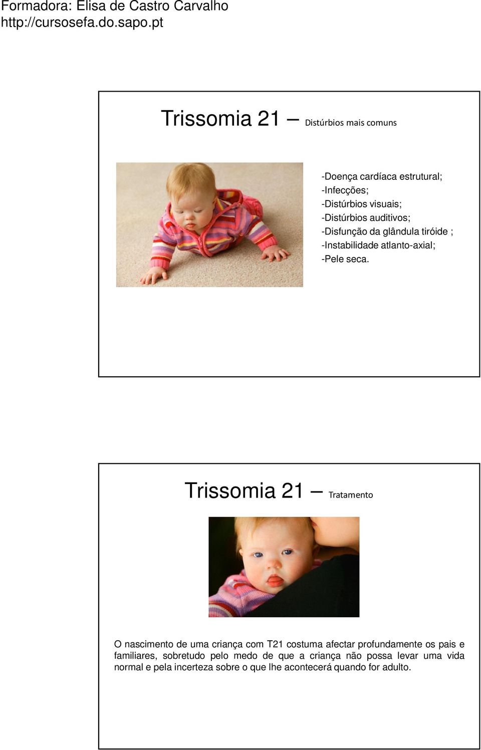 Trissomia 21 Tratamento O nascimento de uma criança com T21 costuma afectar profundamente os pais e