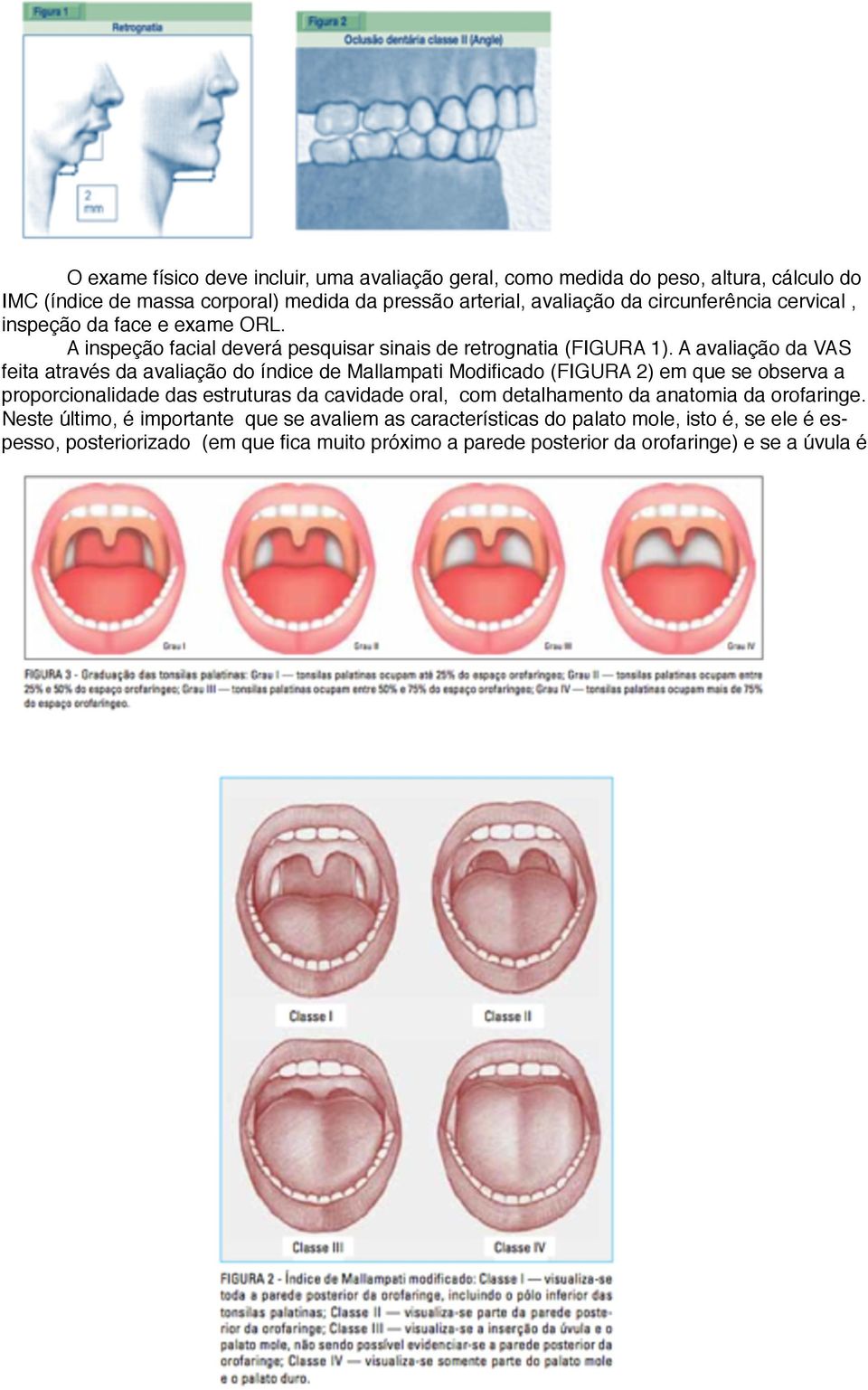 A avaliação da VAS feita através da avaliação do índice de Mallampati Modificado (FIGURA 2) em que se observa a proporcionalidade das estruturas da cavidade oral, com