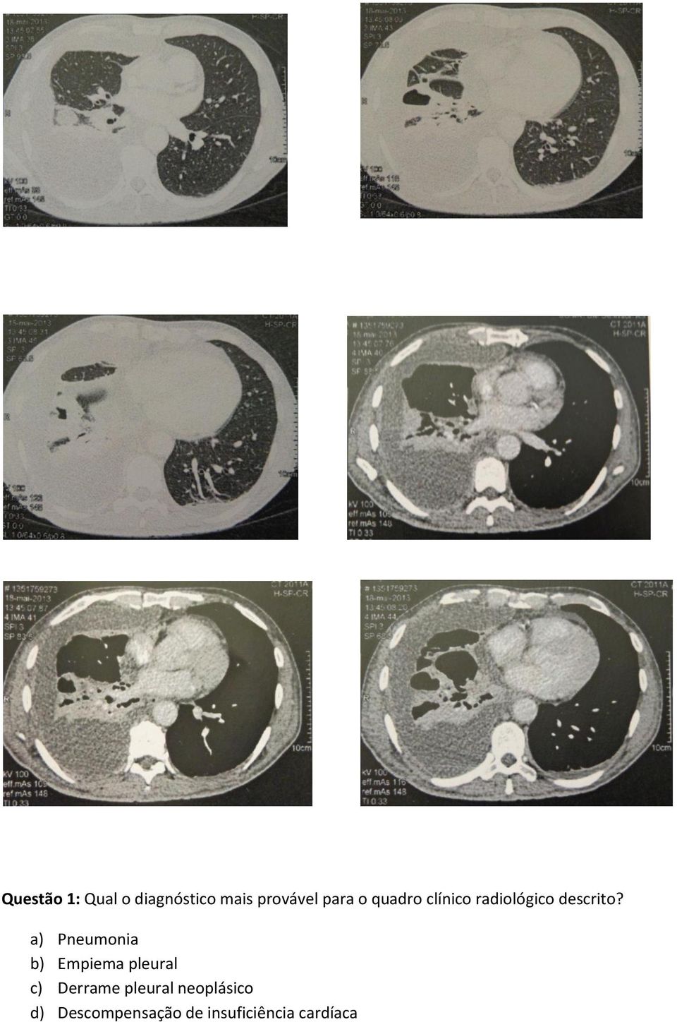 a) Pneumonia b) Empiema pleural c) Derrame