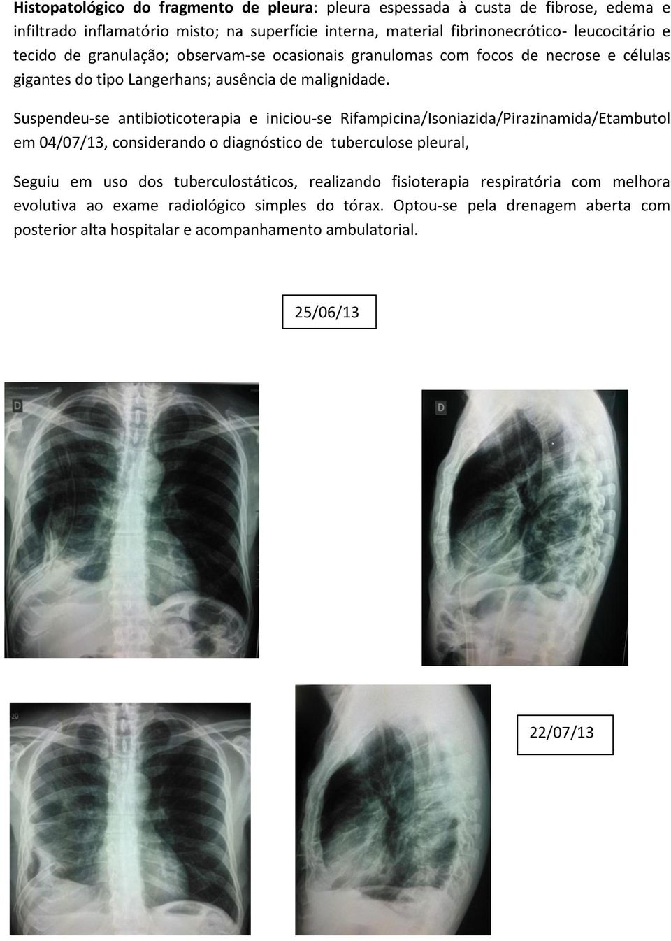 Suspendeu-se antibioticoterapia e iniciou-se Rifampicina/Isoniazida/Pirazinamida/Etambutol em 04/07/13, considerando o diagnóstico de tuberculose pleural, Seguiu em uso dos