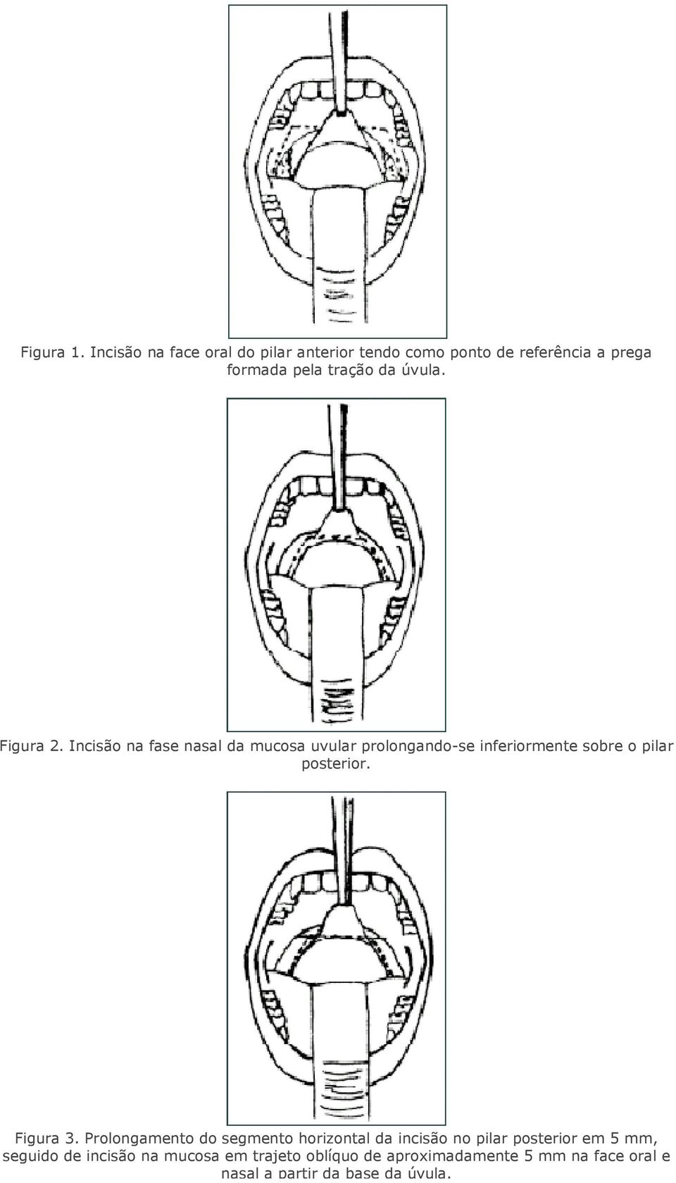 Figura 2. Incisão na fase nasal da mucosa uvular prolongando-se inferiormente sobre o pilar posterior.