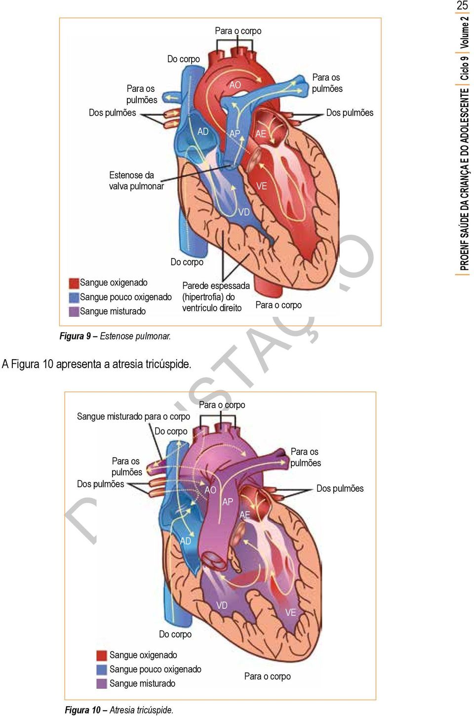 Sangue misturado para o corpo AO AD AP AE VD Parede espessada (hipertrofia) do ventrículo direito AD AO