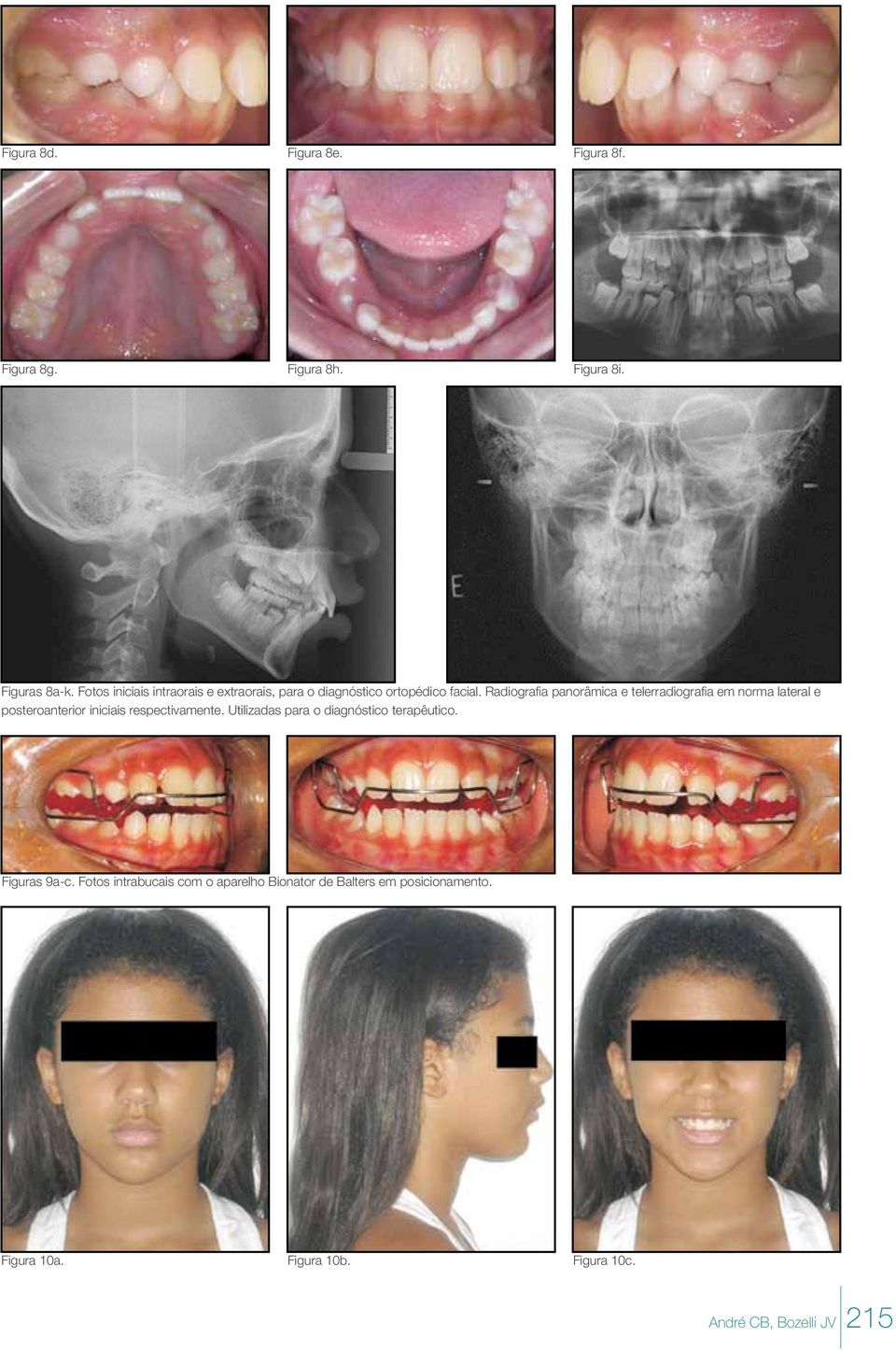 Radiografia panorâmica e telerradiografia em norma lateral e posteroanterior iniciais respectivamente.