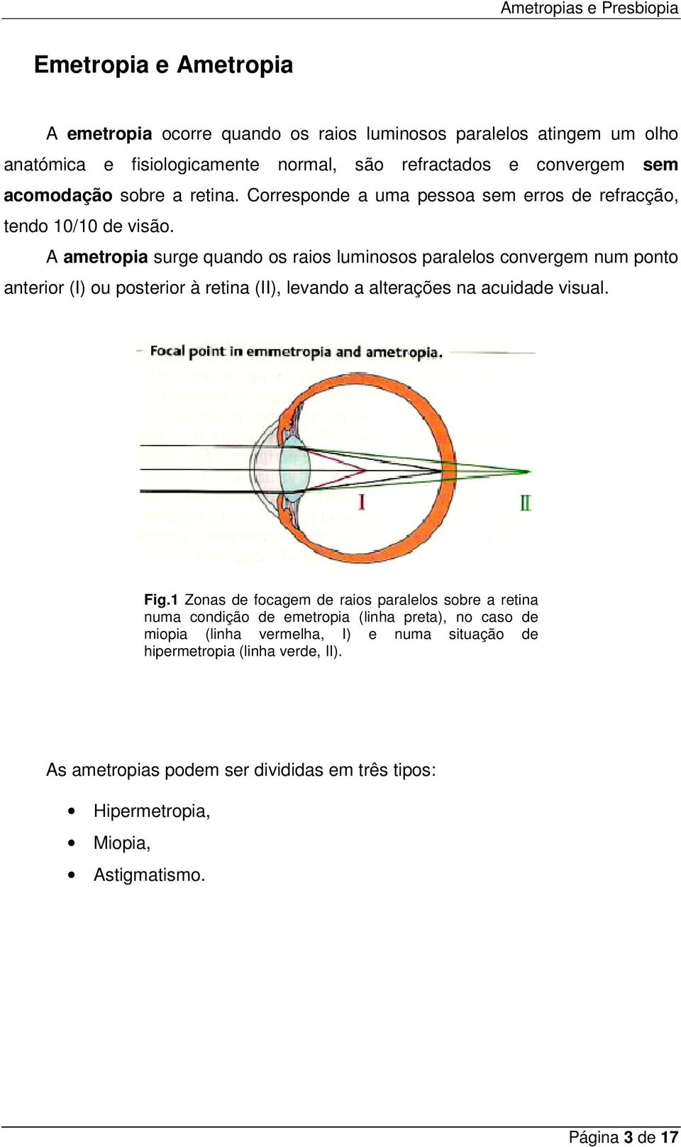 A ametropia surge quando os raios luminosos paralelos convergem num ponto anterior (I) ou posterior à retina (II), levando a alterações na acuidade visual. Fig.