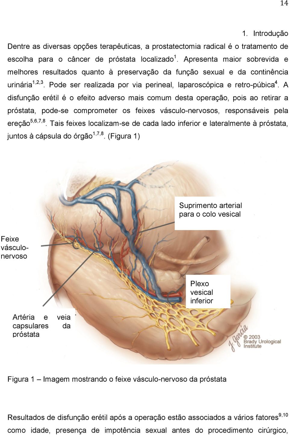 A disfunção erétil é o efeito adverso mais comum desta operação, pois ao retirar a próstata, pode-se comprometer os feixes vásculo-nervosos, responsáveis pela ereção 5,6,7,8.