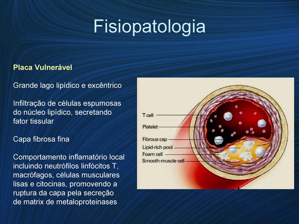 inflamatório local incluindo neutrófilos linfócitos T, macrófagos, células musculares