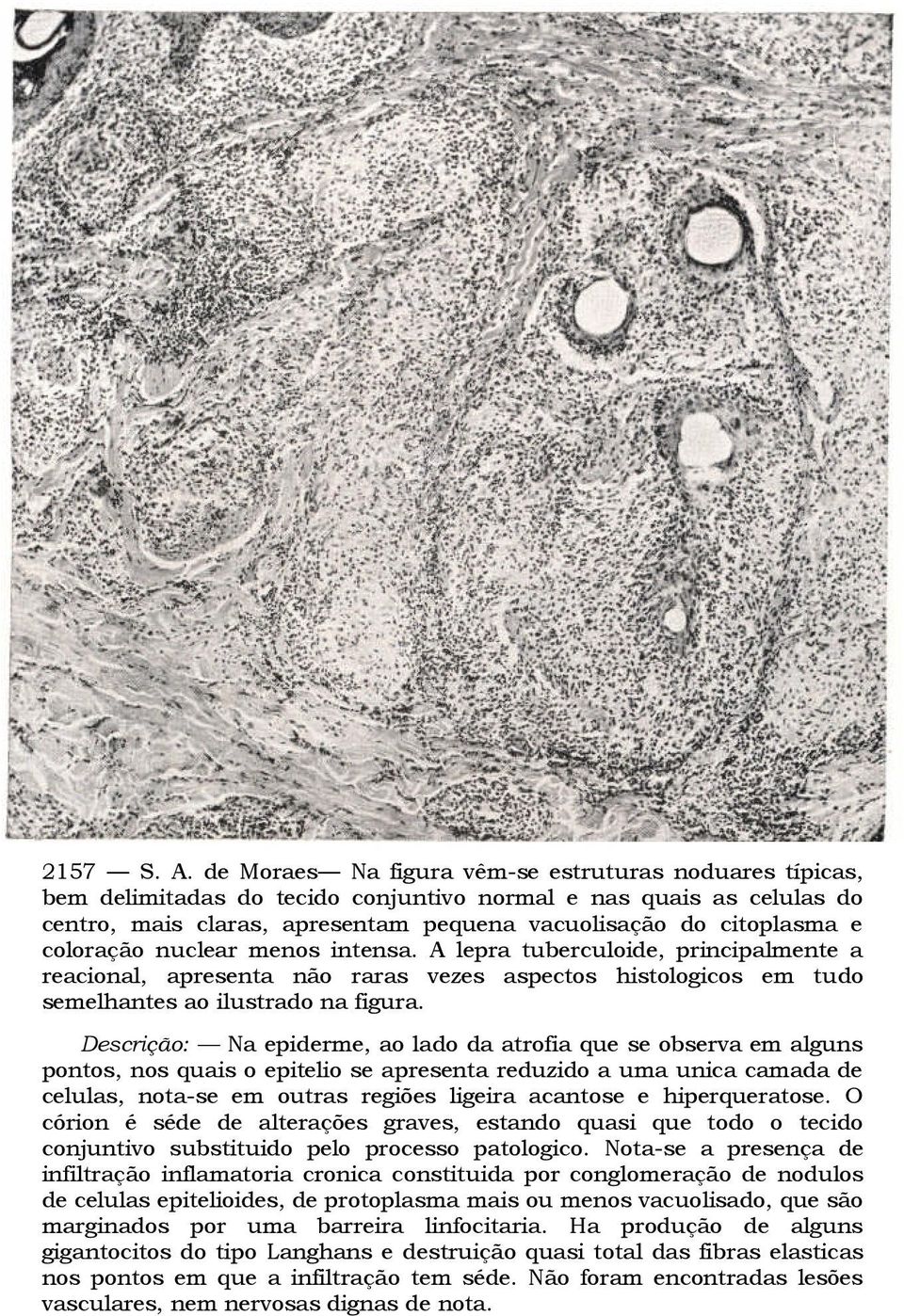 coloração nuclear menos intensa. A lepra tuberculoide, principalmente a reacional, apresenta não raras vezes aspectos histologicos em tudo semelhantes ao ilustrado na figura.