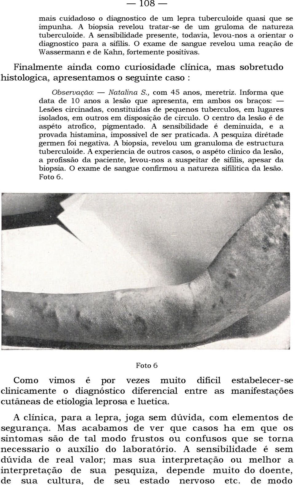 Finalmente ainda como curiosidade clínica, mas sobretudo histologica, apresentamos o seguinte caso : Observação: Natalina S., com 45 anos, meretriz.