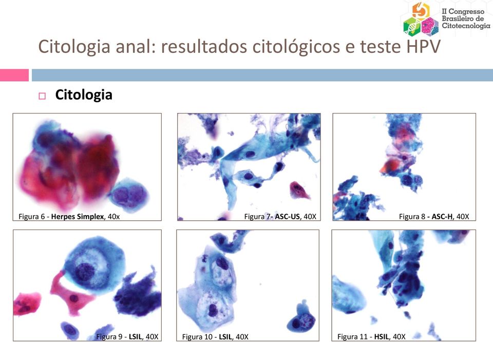 Figura 7- ASC-US, 40X Figura 8 - ASC-H, 40X