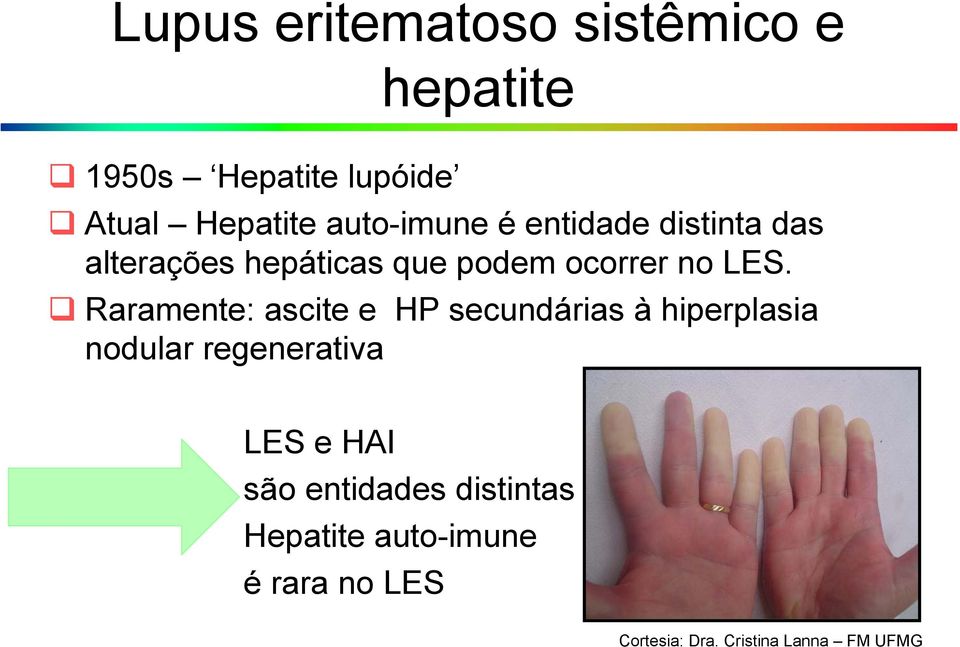 Raramente: ascite e HP secundárias à hiperplasia nodular regenerativa LES e HAI são
