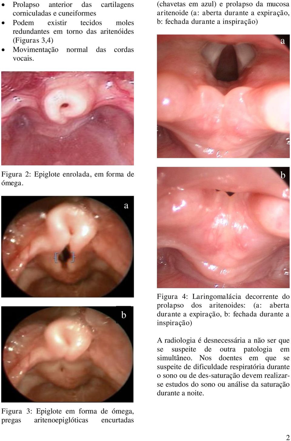 b a b Figura 4: Laringomalácia decorrente do prolapso dos aritenoides: (a: aberta durante a expiração, b: fechada durante a inspiração) A radiologia é desnecessária a não ser que se suspeite de outra