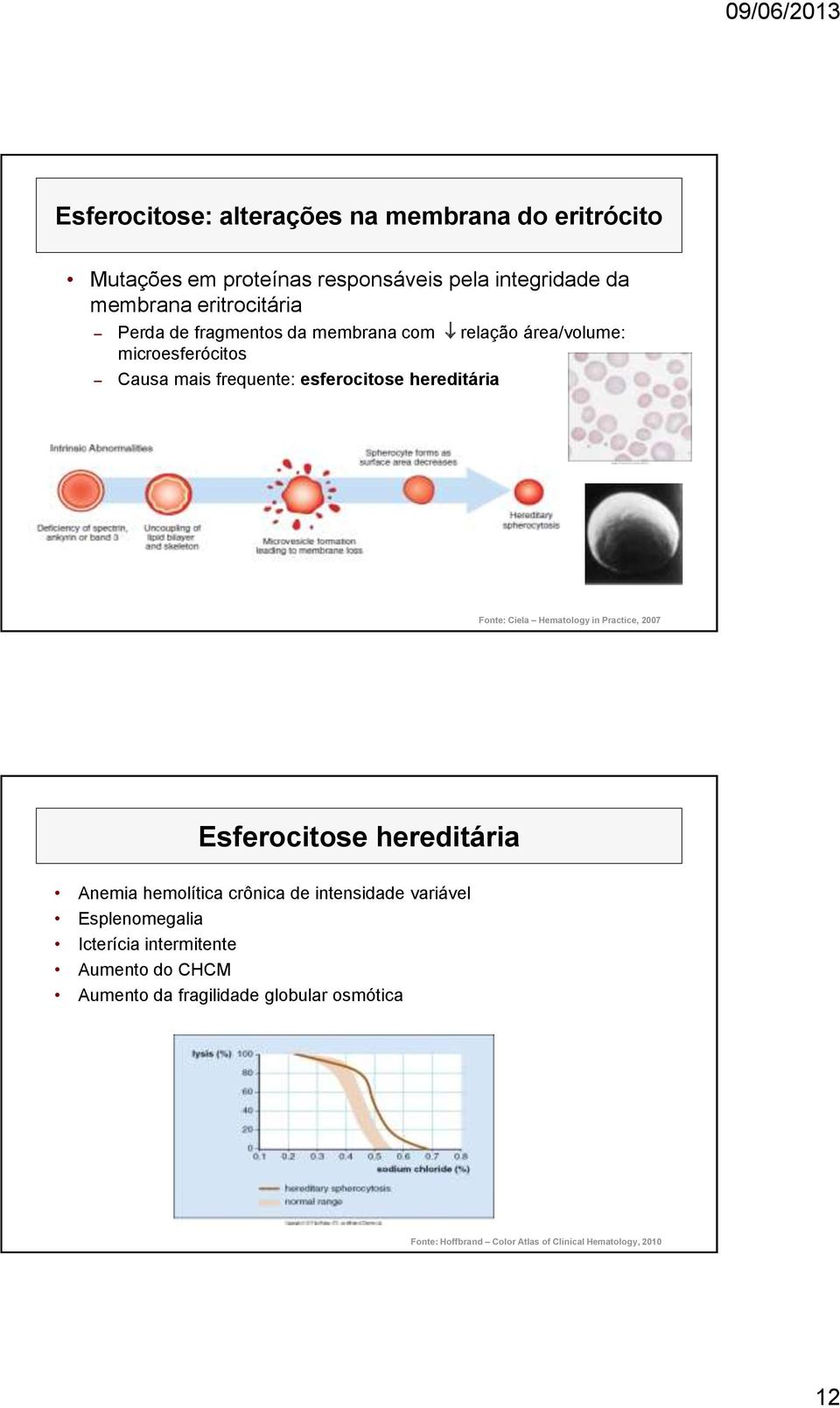 Ciela Hematology in Practice, 2007 Esferocitose hereditária Anemia hemolítica crônica de intensidade variável Esplenomegalia