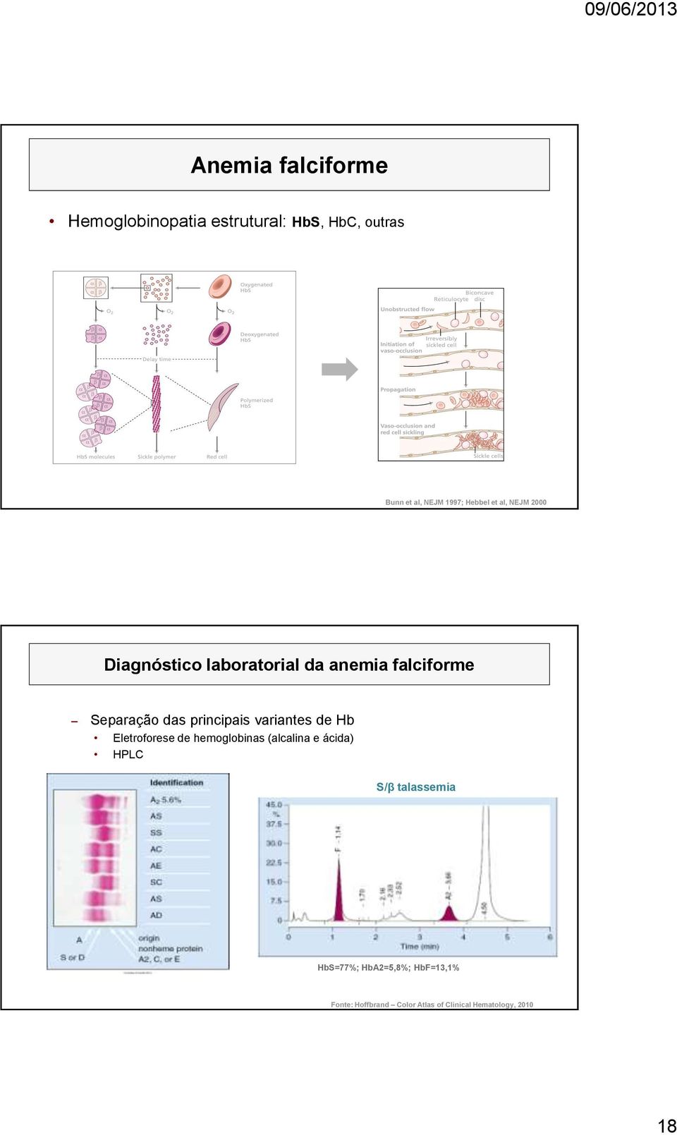 principais variantes de Hb Eletroforese de hemoglobinas (alcalina e ácida) HPLC S/β