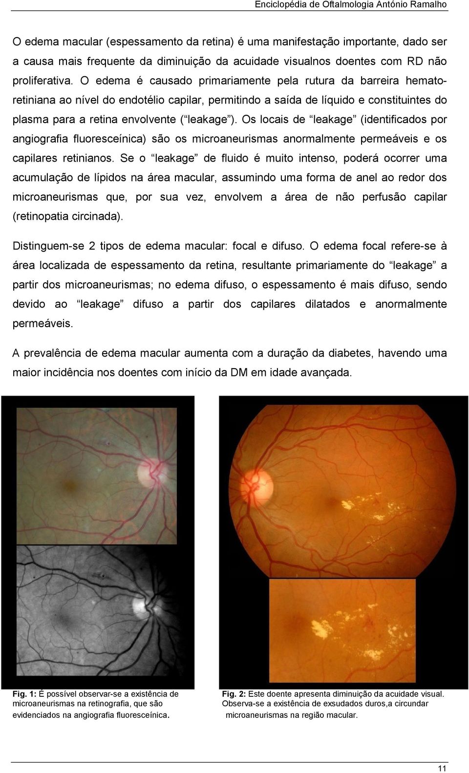 Os locais de leakage (identificados por angiografia fluoresceínica) são os microaneurismas anormalmente permeáveis e os capilares retinianos.