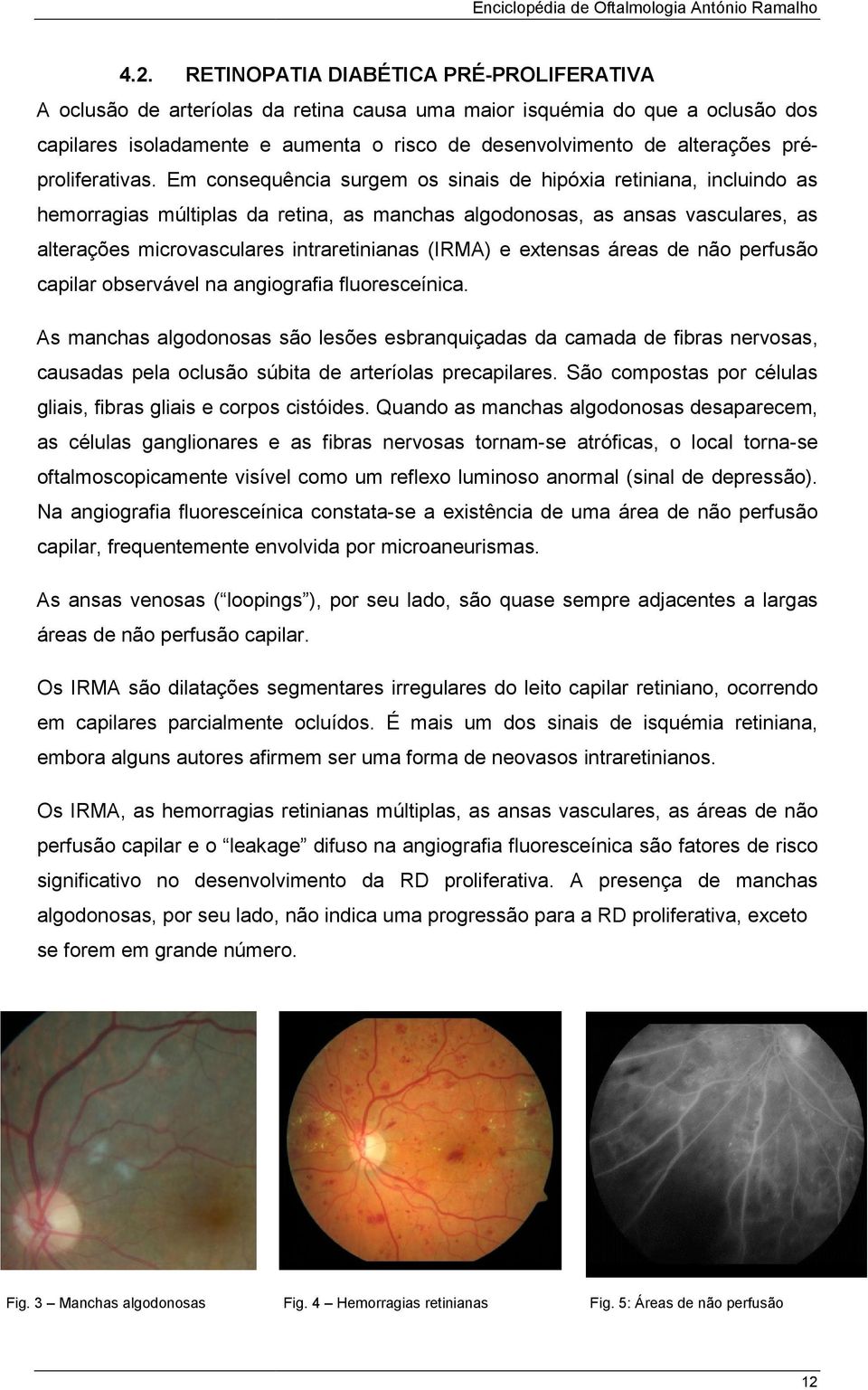 Em consequência surgem os sinais de hipóxia retiniana, incluindo as hemorragias múltiplas da retina, as manchas algodonosas, as ansas vasculares, as alterações microvasculares intraretinianas (IRMA)