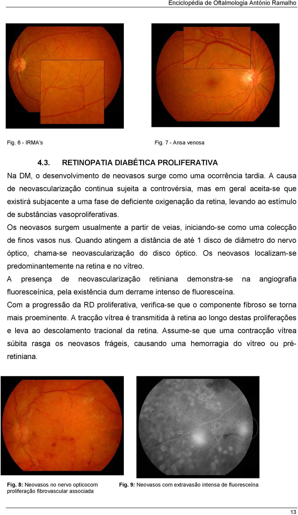 vasoproliferativas. Os neovasos surgem usualmente a partir de veias, iniciando-se como uma colecção de finos vasos nus.