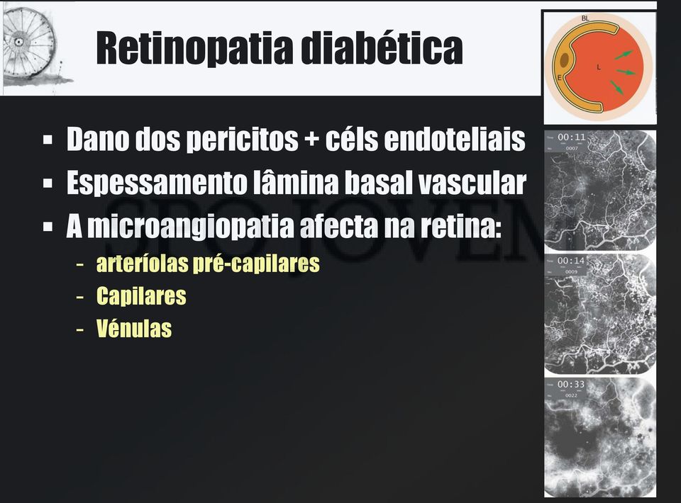 vascular A microangiopatia afecta na retina: