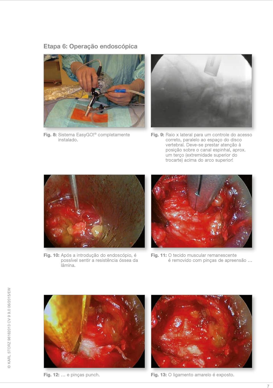 Fig. 10: Após a introdução do endoscópio, é possível sentir a resistência óssea da lâmina. Fig.