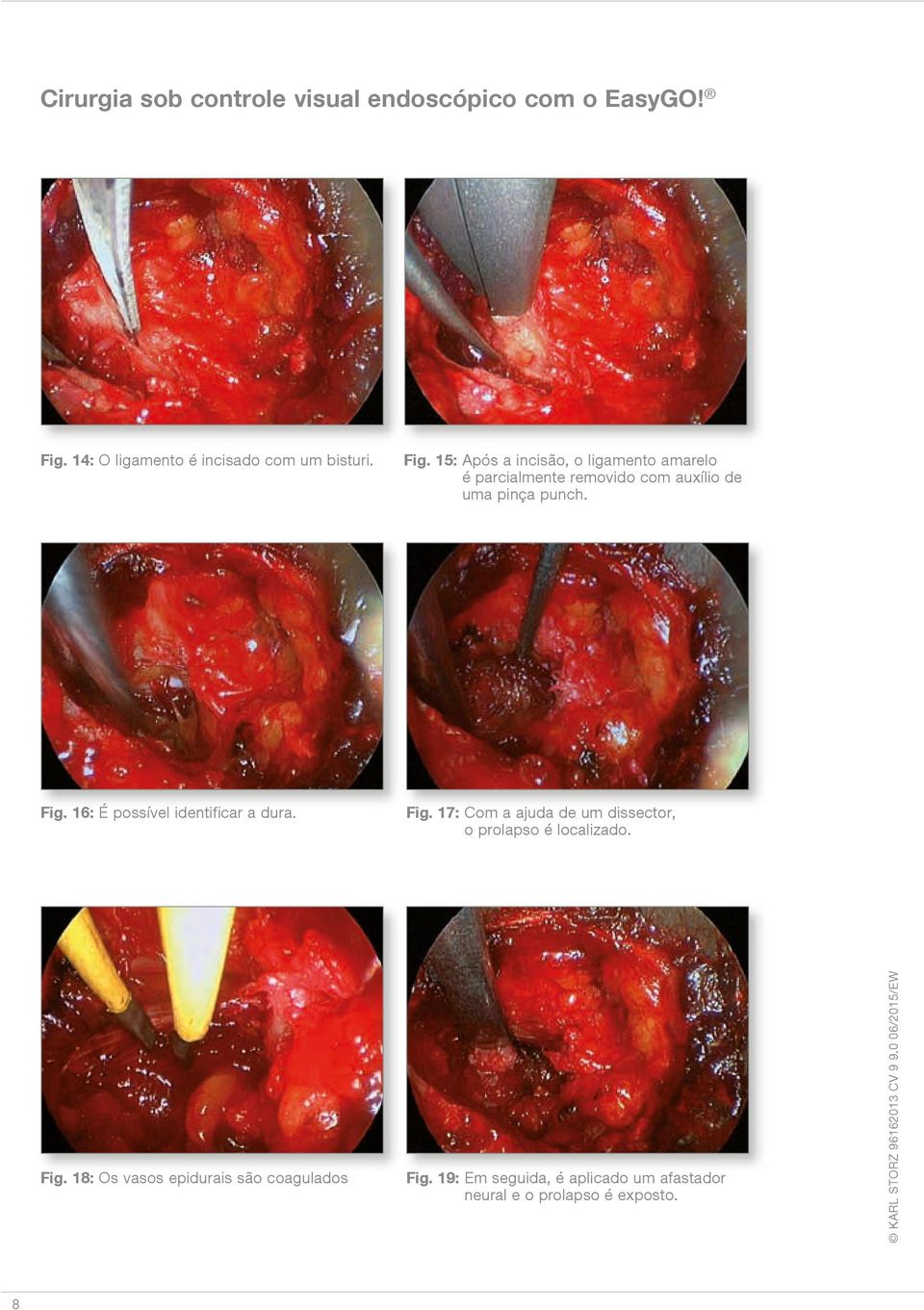 15: Após a incisão, o ligamento amarelo é parcialmente removido com auxílio de uma pinça punch. Fig.