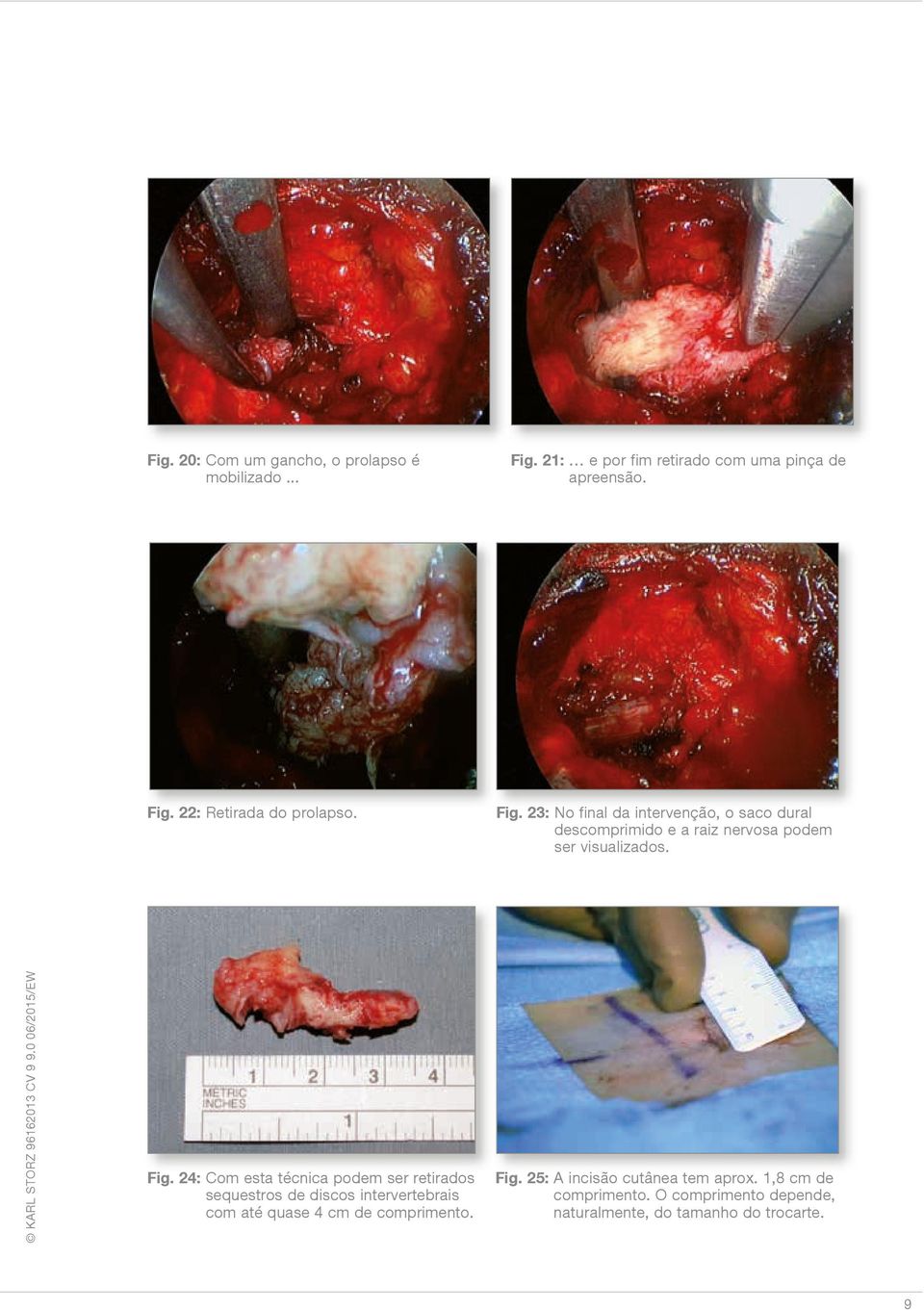 24: Com esta técnica podem ser retirados sequestros de discos intervertebrais com até quase 4 cm de comprimento. Fig.