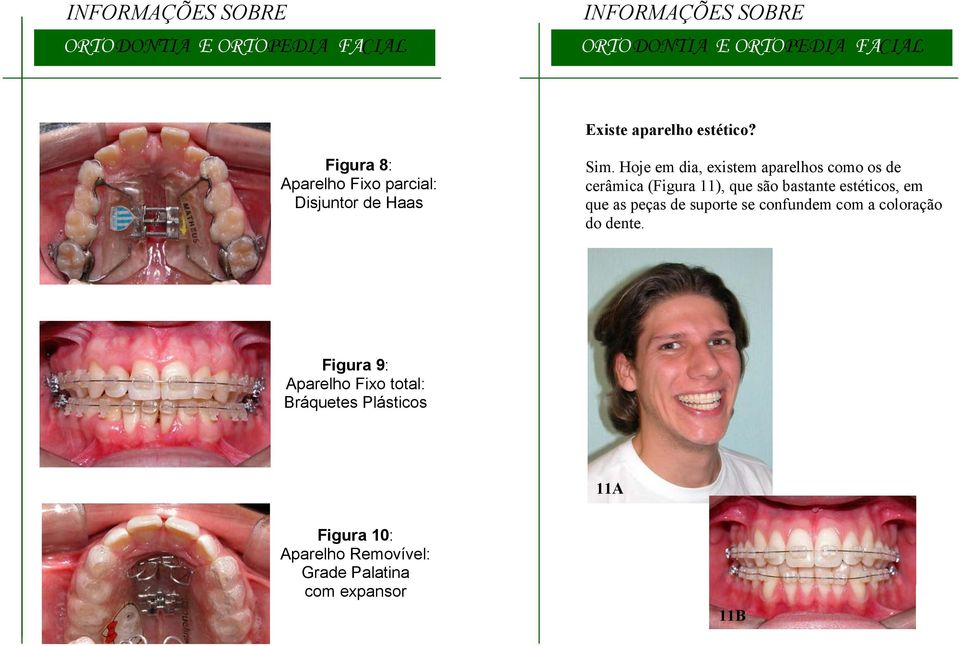 Hoje em dia, existem aparelhos como os de cerâmica (Figura 11), que são bastante estéticos, em que