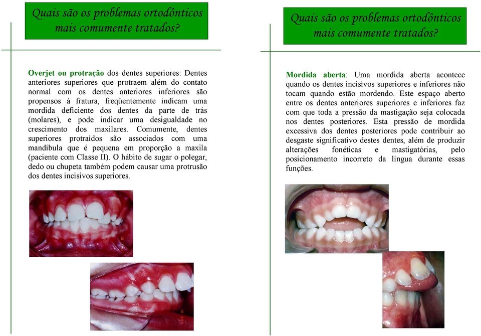 mordida deficiente dos dentes da parte de trás (molares), e pode indicar uma desigualdade no crescimento dos maxilares.