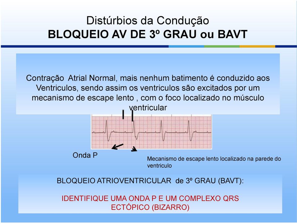 o foco localizado no músculo ventricular Onda P Mecanismo de escape lento localizado na parede do