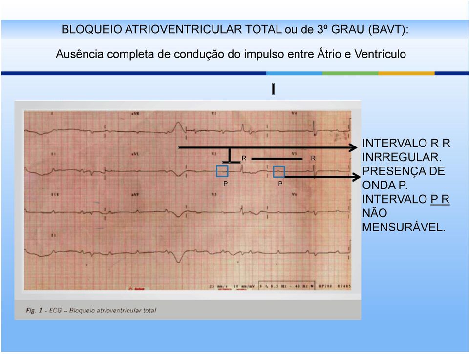 entre Átrio e Ventrículo P R P R INTERVALO R R