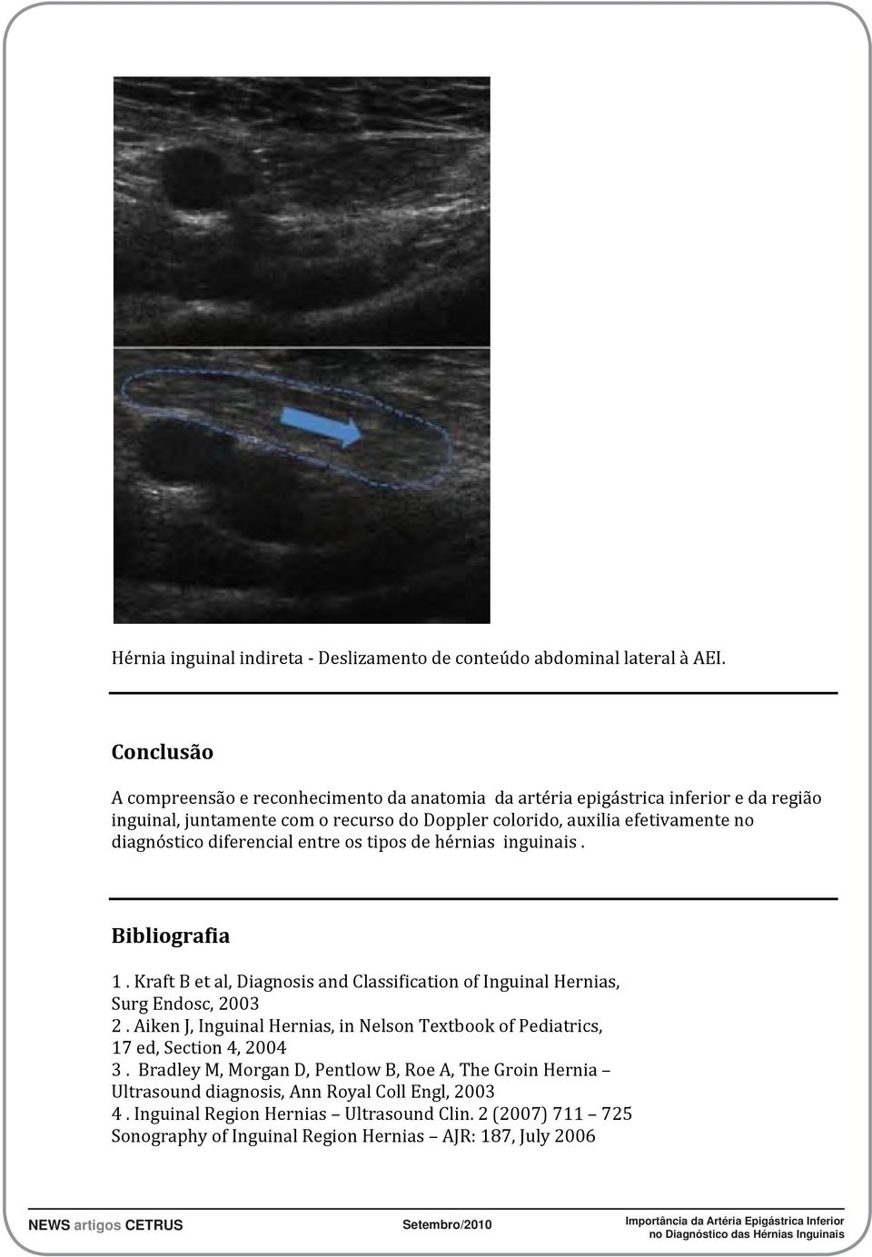 diagnóstico diferencial entre os tipos de hérnias inguinais. Bibliografia 1. Kraft B et al, Diagnosis and Classification of Inguinal Hernias, Surg Endosc, 2003 2.