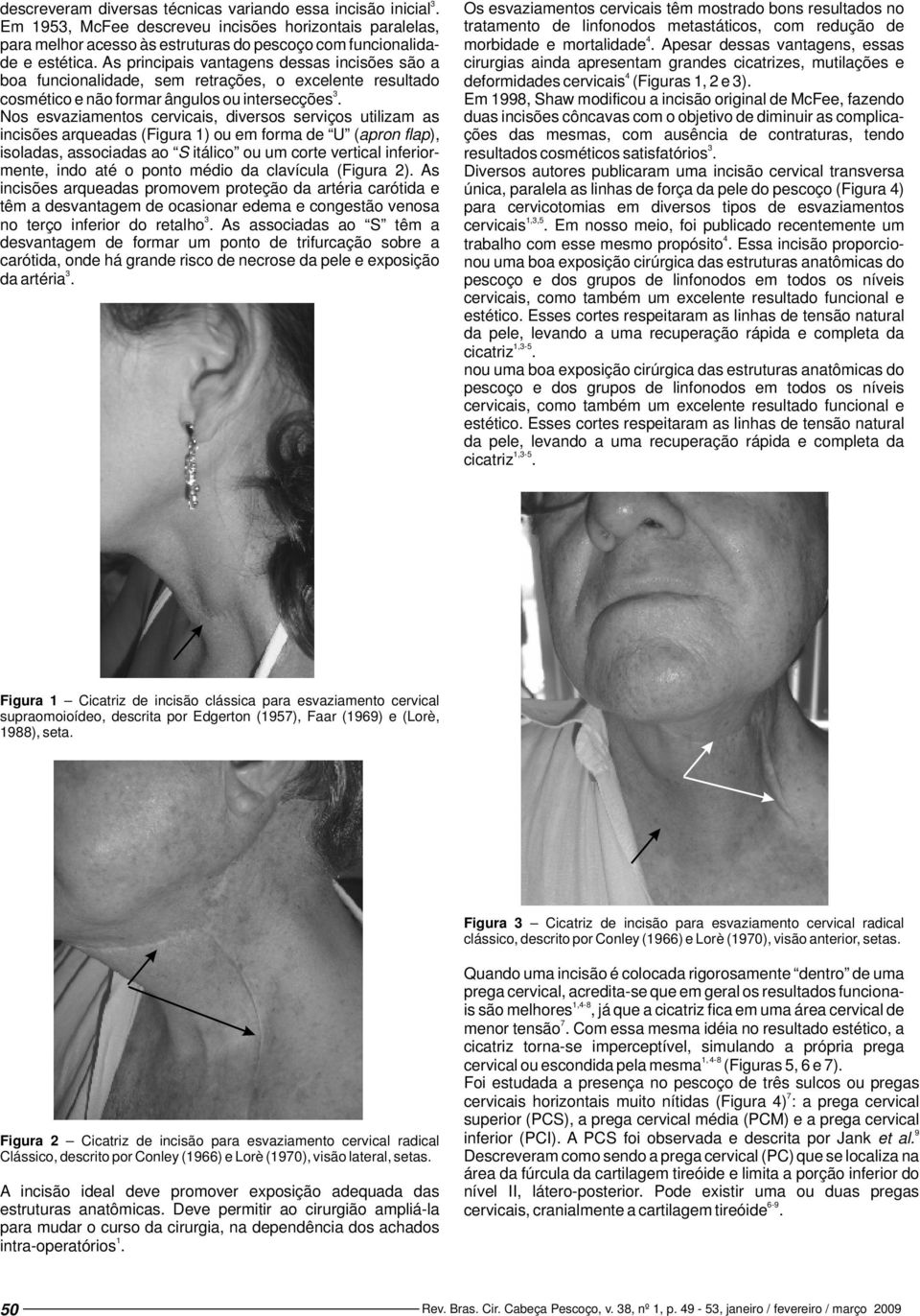 Nos esvaziamentos cervicais, diversos serviços utilizam as incisões arqueadas (Figura ) ou em forma de U (apron flap), isoladas, associadas ao S itálico ou um corte vertical inferiormente, indo até o