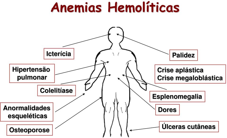 Icterícia Colelitíase Palidez Crise aplástica