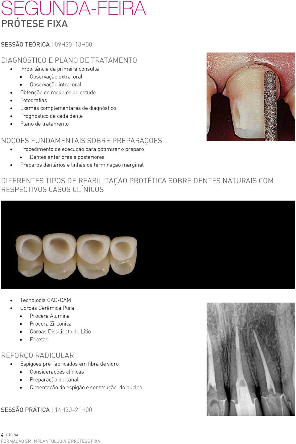 anteriores e posteriores Preparos dentários e linhas de terminação marginal Diferentes Tipos de Reabilitação Protética Sobre Dentes Naturais com Respectivos Casos Clínicos Tecnologia CAD-CAM Coroas