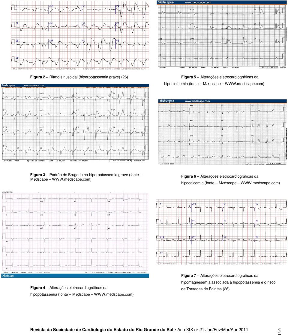 com) Figura 6 Alterações eletrocardiográficas da hipocalcemia (fonte Medscape WWW.medscape.