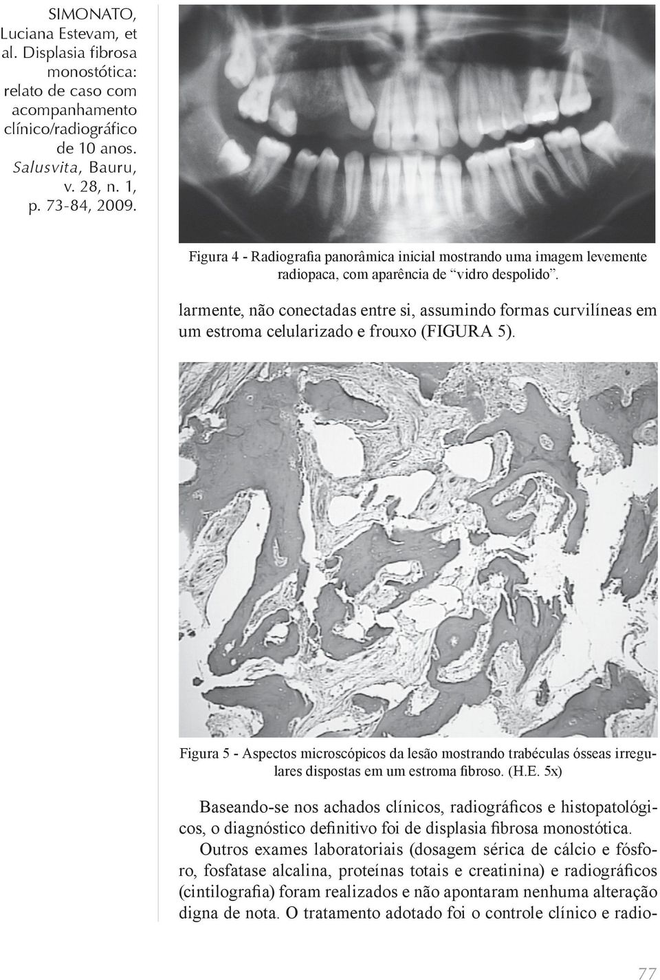 Figura 5 - Aspectos microscópicos da lesão mostrando trabéculas ósseas irregulares dispostas em um estroma fibroso. (H.E.