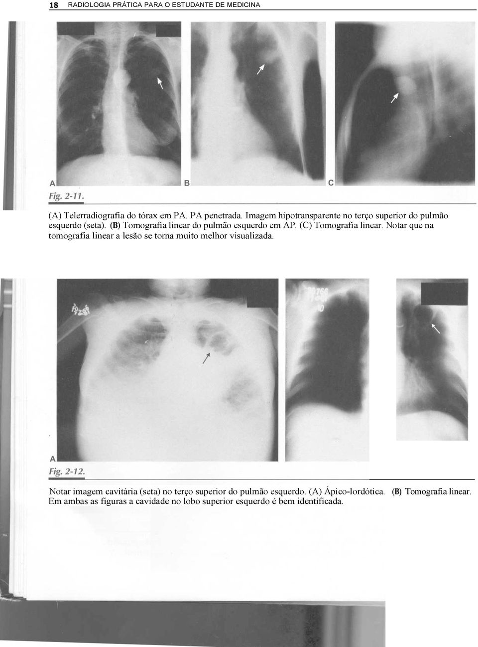 (C) Tomografia linear. Notar que na tomografia linear a lesão se torna muito melhor visualizada.