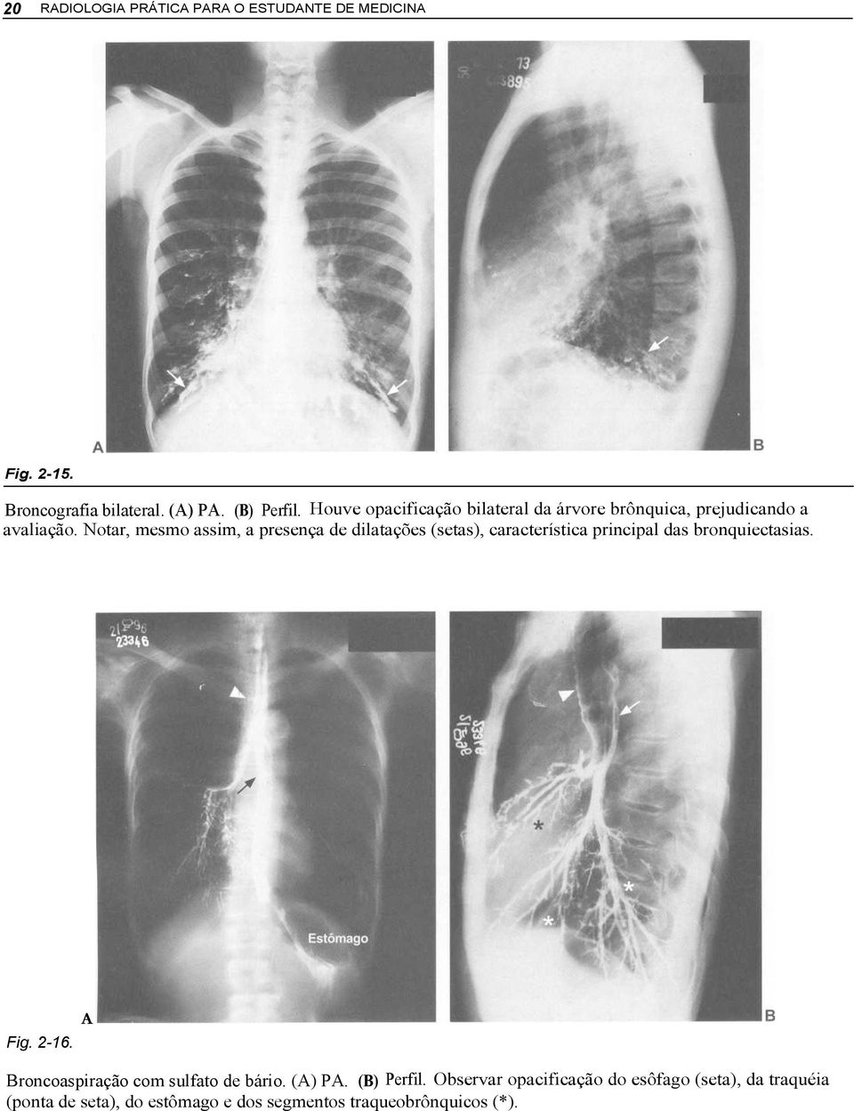 Notar, mesmo assim, a presença de dilatações (setas), característica principal das bronquiectasias. Fig. 2-16.