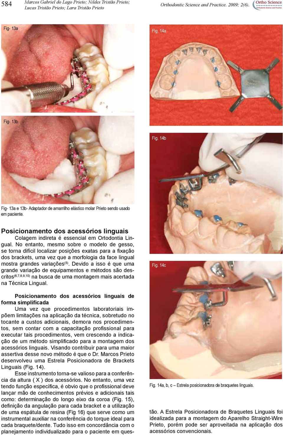 No entanto, mesmo sobre o modelo de gesso, se torna difícil localizar posições exatas para a fixação dos brackets, uma vez que a morfologia da face lingual mostra grandes variações (5).