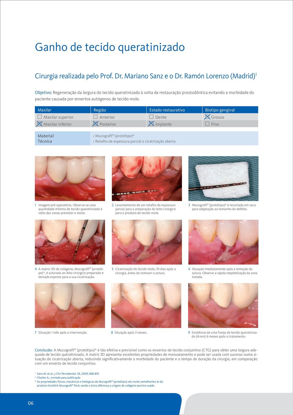 Maxilar Região Estado restaurativo Biotipo gengival Maxilar superior Anterior Dente Grosso Maxilar inferior Posterior Implante Fino Material Técnica > Mucograft (protótipo)* > Retalho de espessura