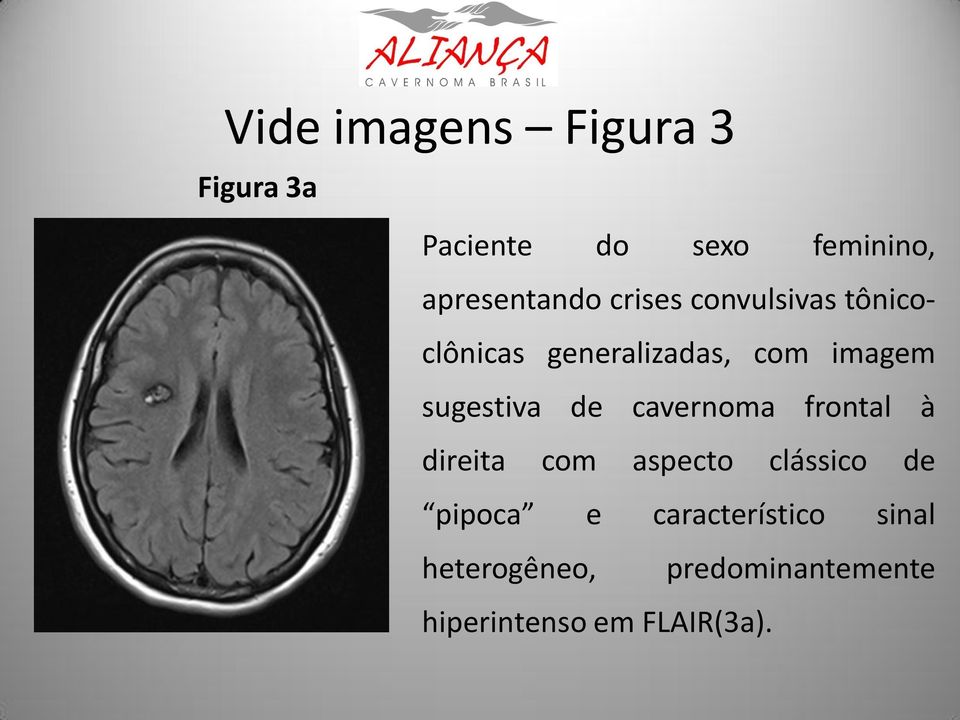 imagem sugestiva de cavernoma frontal à direita com aspecto clássico