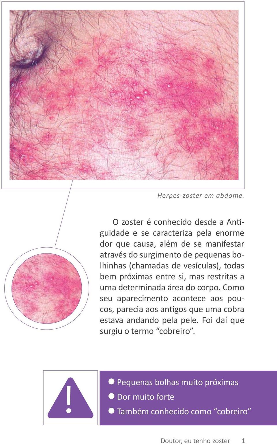 de pequenas bolhinhas (chamadas de vesículas), todas bem próximas entre si, mas restritas a uma determinada área do corpo.