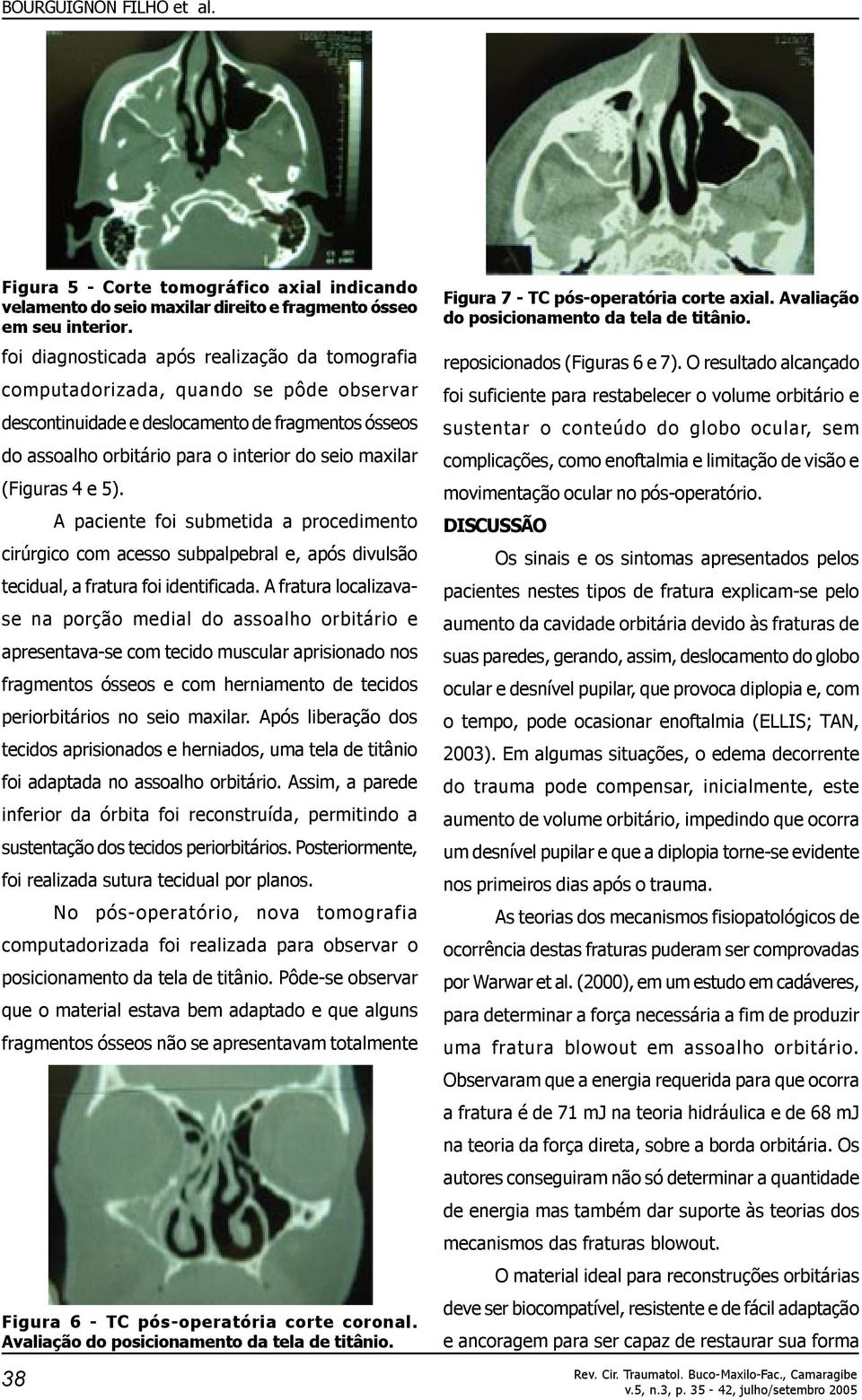 (Figuras 4 e 5). A paciente foi submetida a procedimento cirúrgico com acesso subpalpebral e, após divulsão tecidual, a fratura foi identificada.